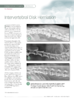 Intervertebral Disk Herniation