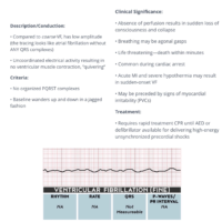 Nclex Ekg Ventricular Fibrillation (Fine)