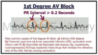 1st Degree AV Block – Cardiac Nursing Notes