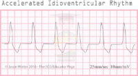 Accelerated İdioventricular Rhythm – ECG Result