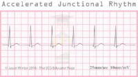 Accelerated Junctional Rhythm – ECG Result