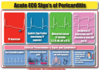 Acute ECG Signs Of Pericarditis – Cardiac Notes