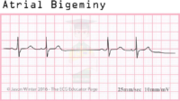 Atrial Bigeminy – ECG Result – Nursing Notes For Exam