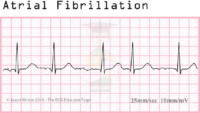 Atrial Fibrillation – ECG Result