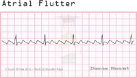 Atrial Flutter – ECG Result