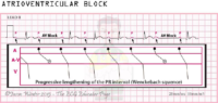 Atrioventricular Block – ECG Result – Nursing Notes