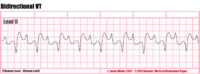Bidirectional VT – Cardiac Nursing Notes