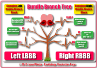 Bundle Branch Tree – Left And Right LBBB