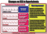 Changes On ECG İn Hyperkalemia