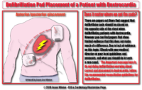 Defibrillation Pad Placement Of A Patient With Dextrocardia – Cardiac Nursing Notes