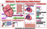 ECG Basics – Wolff – Parkinson – White Pattern