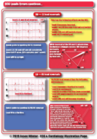 ECG Limb Lead Reversal Errors – Cardiac Syndromes – 2