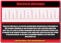 Electriacal Alternans – Cardiac Nursing Notes