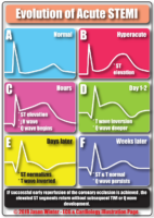 Evolution Of Acute STEMI – Cardiac Nursing Notes
