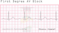 First Degree AV Block – ECG Result