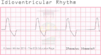 İdioventricular Rhytm – ECG Result