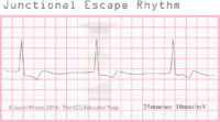 Junctional Escape Rhythm – ECG Result