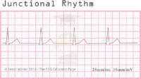 Junctional Rhythm – ECG Result