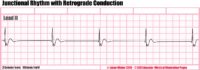 Junctional Rhythm With Retrograde Conduction