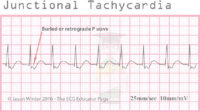 Junctional Tachycardia – ECG Result