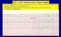 Left Ventricular Hypertrophy Example Ecg Result