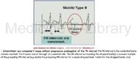 Mobitz Type 2 Examples – ECG Result