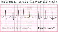 Multifocal Atrial Tachycardia (MAT) – ECG Result