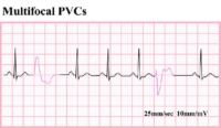 Multifocal PVCs – ECG Result For Nursing Exam