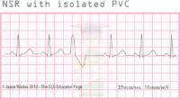 NSR With İsolated PVC – ECG Result