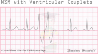 NSR With Ventricular Couplets – ECG Result