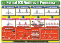Normal ECG Findings İn Pregnancy – Cardiac Nursing Notes