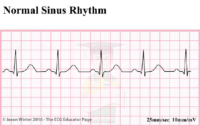 Normal Sinus Rhytm – ECG Result