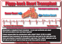 Piggy-Back Heart Transplant – Cardiac Nursing Notes
