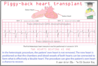 Piggy Back Heart Transplant – Two Distinct Rates
