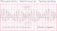 PolyMorphic Ventricular Tachycardia – ECG Result