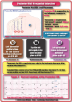 Posterior Wall Myocardial İnfarction – Nursing Exam Notes