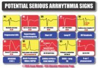 Potential Serious Arrhythmia Signs – Cardiac Nursing Notes