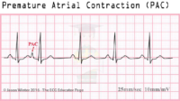 Premature Atrial Contraction (PAC) – ECG Result