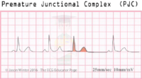 Premature Junctional Complex (PJC) – ECG Result