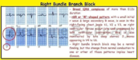 Right Bundle Branch Block – Cardiac Nursing Notes