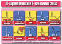 ST – Segment Depression – T Wave İnversion Cause