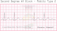 Second Degree AV Block – Mobitz Type 2 – ECG Result
