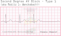 Second Degree AV Block – Type L – ECG Result