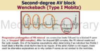 Second Degree AV Block Wenckebach – Cardiac Nursing Notes