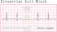 Sinoatrial Exit Block – ECG Result