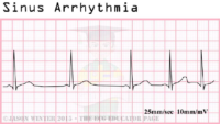 Sinus Arrhythmia – ECG Result For Nursing Exam