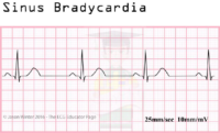 Sinus Bradycardia – ECG Result – Nursing Exam Notes