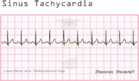 Sinus Tachycardia – ECG Result
