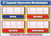 St Segment Depression Morpholohies – Cardiac Nursing Notes