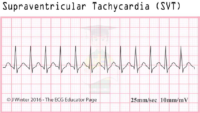 Supraventicular Tachycardia – SVT – ECG Result